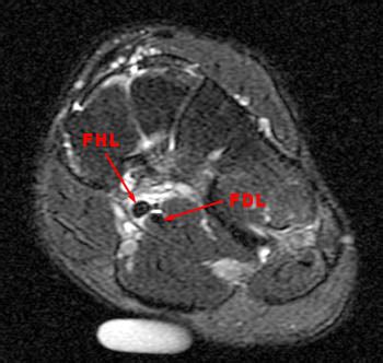 MRI Musculo-Skeletal Section: Flexor hallucis longus tenosynovitis at ...