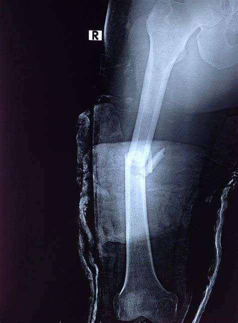 Fracture of the Femoral Shaft