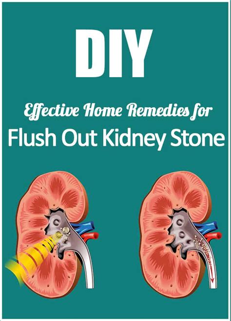 DIY Natural Remedies for Kidney Stones