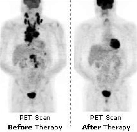 CANCER 101: PET SCANS | East Brunswick, NJ Patch