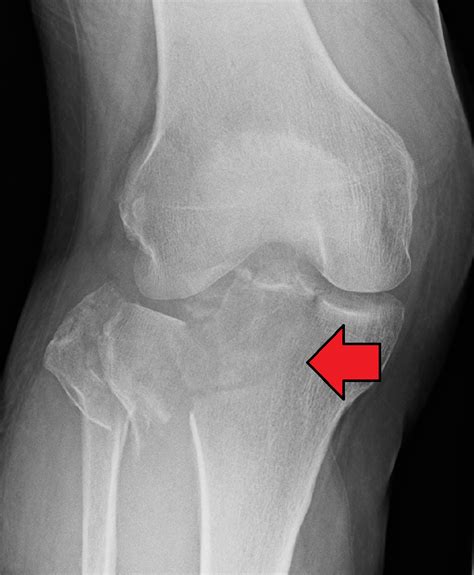 Tibial Plateau – Earth's Lab