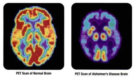 Alzheimer’s Tau Proteins Look Different and Spread Faster in Women Than ...