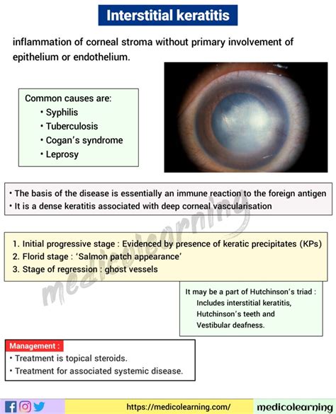 Interstitial Keratitis – MedicoLearning