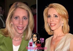 Dana Bash Plastic Surgery Before & After - Plastic Surgery Talks