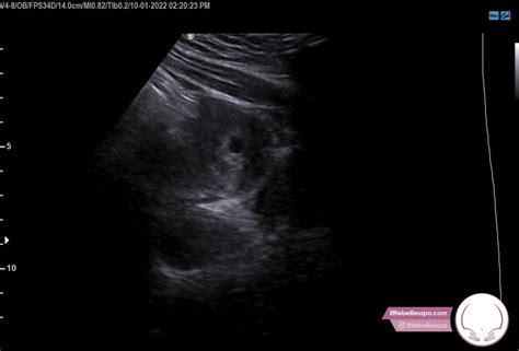 LEEP vs Repeat Colposcopy for CIN-2 : r/obgyn