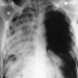 Chest radiograph taken during mechanical ventilation showing a left... | Download Scientific Diagram