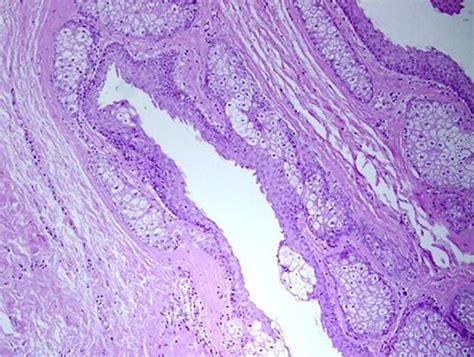 Steatocystoma Multiplex Histology