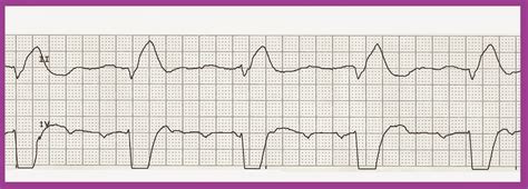 Float Nurse: Practice EKG Strips 417