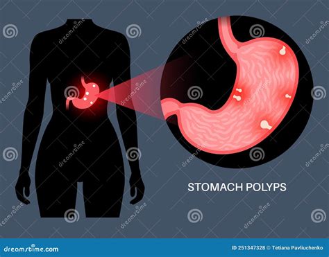 Stomach Polyps. Cross Section Of Human Stomach With Gastric Polyp ...