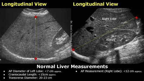 How To Measure Liver On Ultrasound | Craniocaudal Length, Transverse, Volume & AP Measurements ...