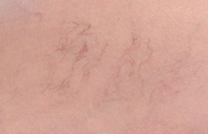 Tiny Spider Veins / Telangiectasia - BioBalance Skin