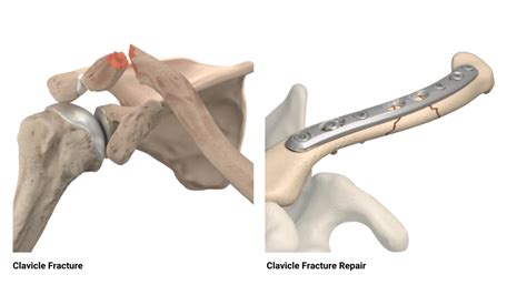 Clavicle Fractures | Dr. Edward S. Chang, MD