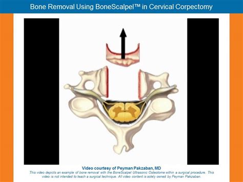 Anterior Cervical Corpectomy - YouTube