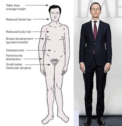 Klinefelter Syndrome Body