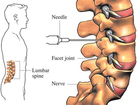 FACET JOINT INJECTIONS FOR BACK PAIN – South Florida Health and Wellness Magazine