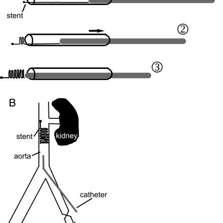 Schematic diagram of stent deployment (A) and procedure (B). (A): (1 ...