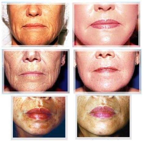 Glycolic Peels - Before and After | Chemical peel, Peeling skin, Acne scar removal