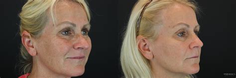 Forever Young BBL Before and After Pictures Case 203 | Glen Carbon, IL | MidAmerica Plastic Surgery