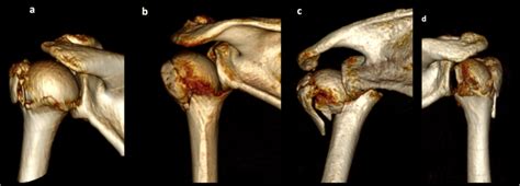 Valgus-impacted fractures (VL). a 3D reconstruction of valgus-impacted... | Download Scientific ...