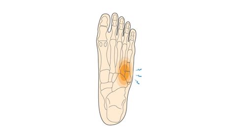 New shoes, immediate 5th metatarsal area pain, what does it mean? : r/BBallShoes