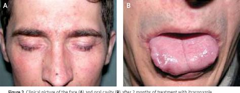 Figure 1 from Chronic mucocutaneous candidiasis with endocrinopathy ...