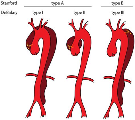 Acute aortic dissection: pathogenesis, risk factors and diagnosis