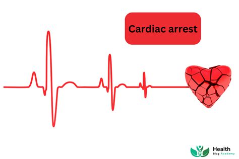 Cardiac Arrest - Causes, Symptoms, and Treatment - Health Blog Academy