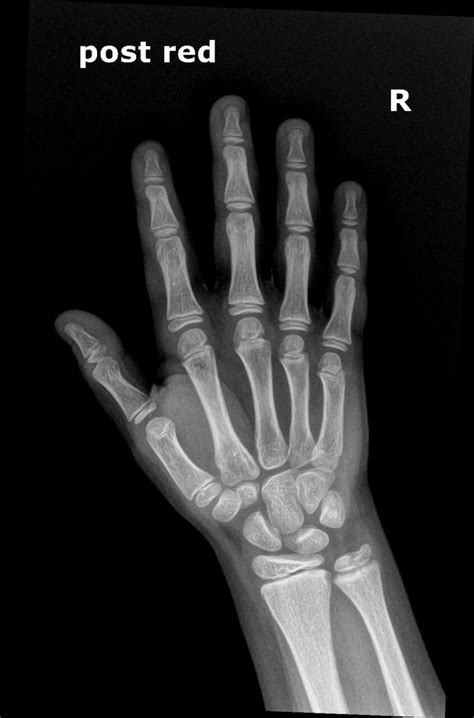 OrthoDx: Thumb Dislocation in Child - Clinical Advisor