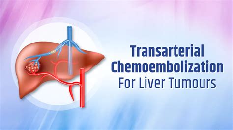 Transarterial Chemoembolization (TACE) for Liver Tumors - Dr. Harsh J Shah