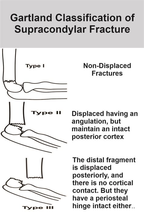 Gartland Classification Of Supracondylar Fracture | Humerus fracture, Compartment syndrome, Fracture