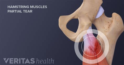 Hamstring Tears: Signs and Symptoms