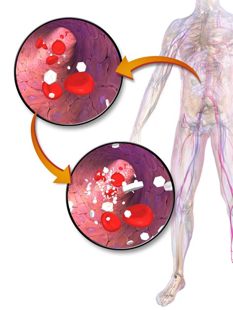 Hyperglycemia - Wikipedia