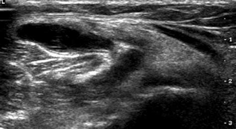 Understanding Baker's Cyst on Ultrasound: Causes and Symptoms