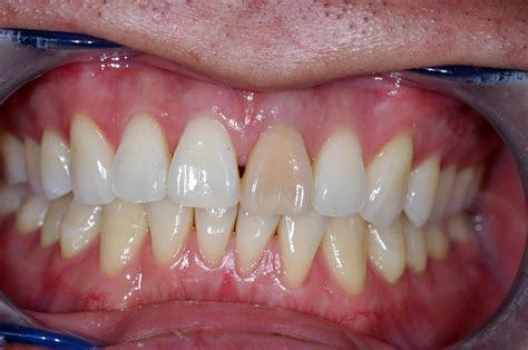 What causes permanent yellowish discoloration on teeth?