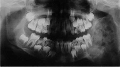 Initial panoramic radiograph showing patient in mixed dentition and ...