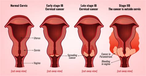 Cervical Cancer Stages | Prof Andreas Obermair » Professor Andreas Obermair