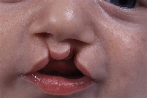 The physical and psychological effects of cleft lip and palate | Cleft lip, Cleft lip and palate