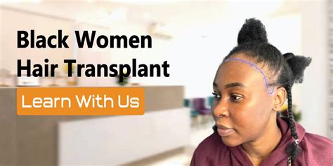 Black Women Hair Transplant Hair Transplantation for Black Females » Dr. Gökhan Bircan