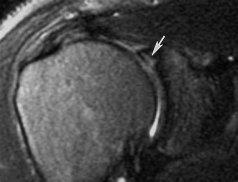 MRI Musculo-Skeletal Section: Signs of SLAP lesions.