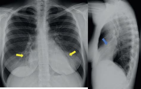 Acute Asthma Exacerbation | Radiology Key