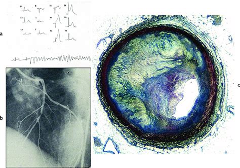 Vasospasm as a cause of SCD in a young. (a) ECG with transient ischemia ...