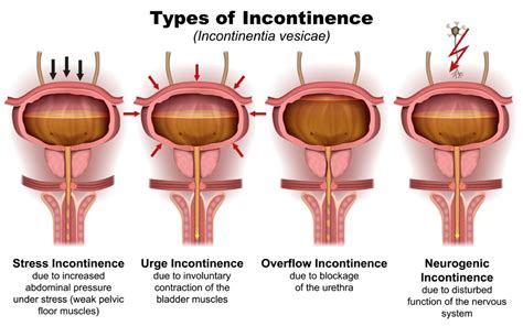 Causes & Types of Stress Urinary Incontinence – Chicago Urogynecology