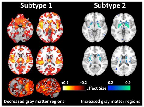 Researchers discover second type of schizophrenia in 2020 | Types of schizophrenia, Brain scan ...