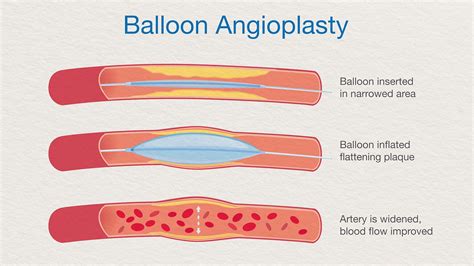 What You Can Do to Prevent Atherosclerosis | Everyday Health