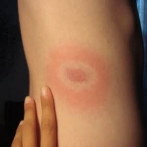 Staphylococcal Infections: Causes, Symptoms, Prevention And Treatment. - INFORMATION NIGERIA