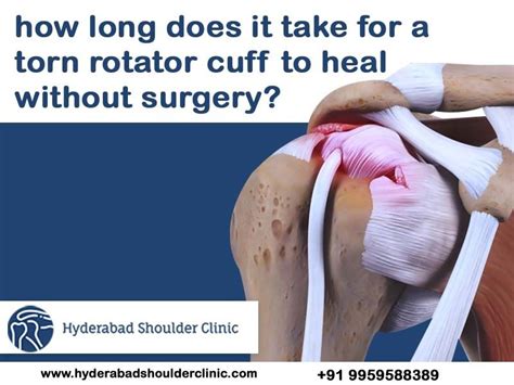 How long does it take for a torn rotator cuff to heal without surgery? | Rotator cuff injury ...