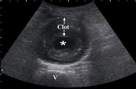 Ruptured Abdominal Aortic Aneurysm Ultrasound