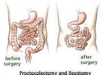 Proctocolectomy with Permanent Ileostomy - Bing Images | Ileostomy, Digestive health, Ostomy