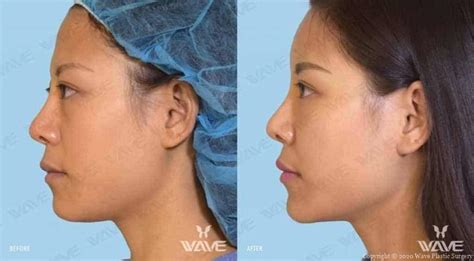 Facial Fat Transfer in Los Angeles | Wave Plastic Surgery