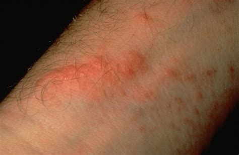 Poison Ivy Rash: How to Avoid it For Good | Angie's List